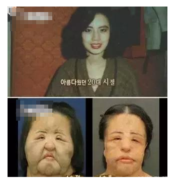 整容發生意外保險賠嗎？